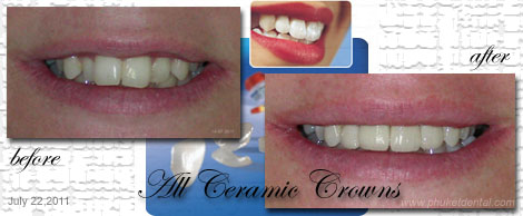 All ceramic crowns&bridges:Phuket Dentist,Thailand
